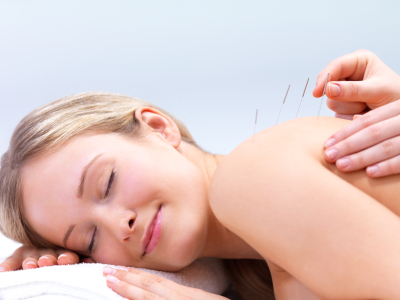 Acupuncture needles on the back of a beautiful woman acupuncture stress